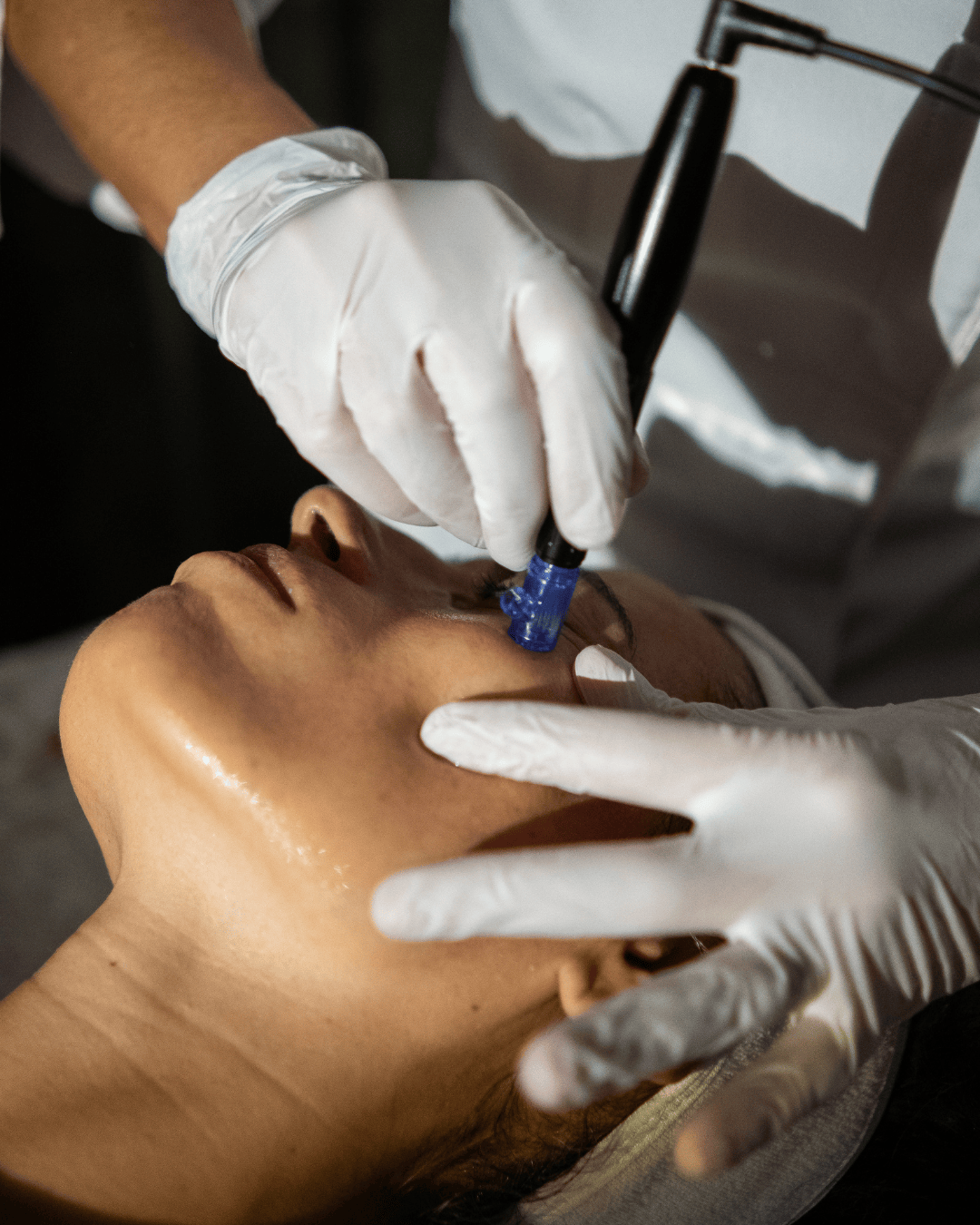 Fiumara Centro Benessere - Micro-needling